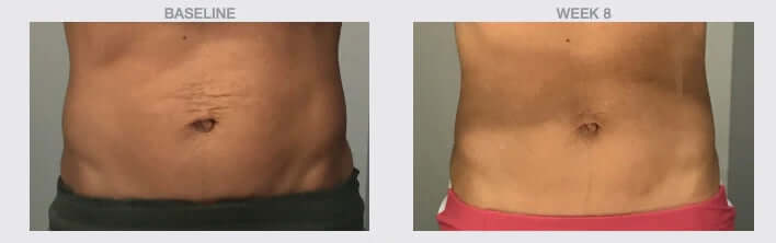 Smooth body lotion before and after 8 weeks results showing improved skin texture and reduced appearance of cellulite