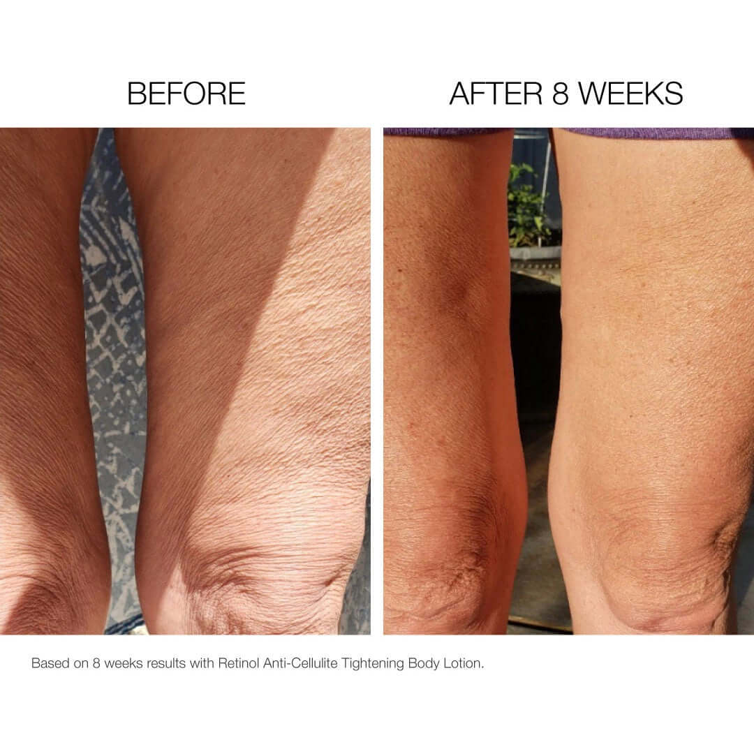 Smooth body lotion before and after 8 weeks showing reduced cellulite and smoother firmer skin texture on knees