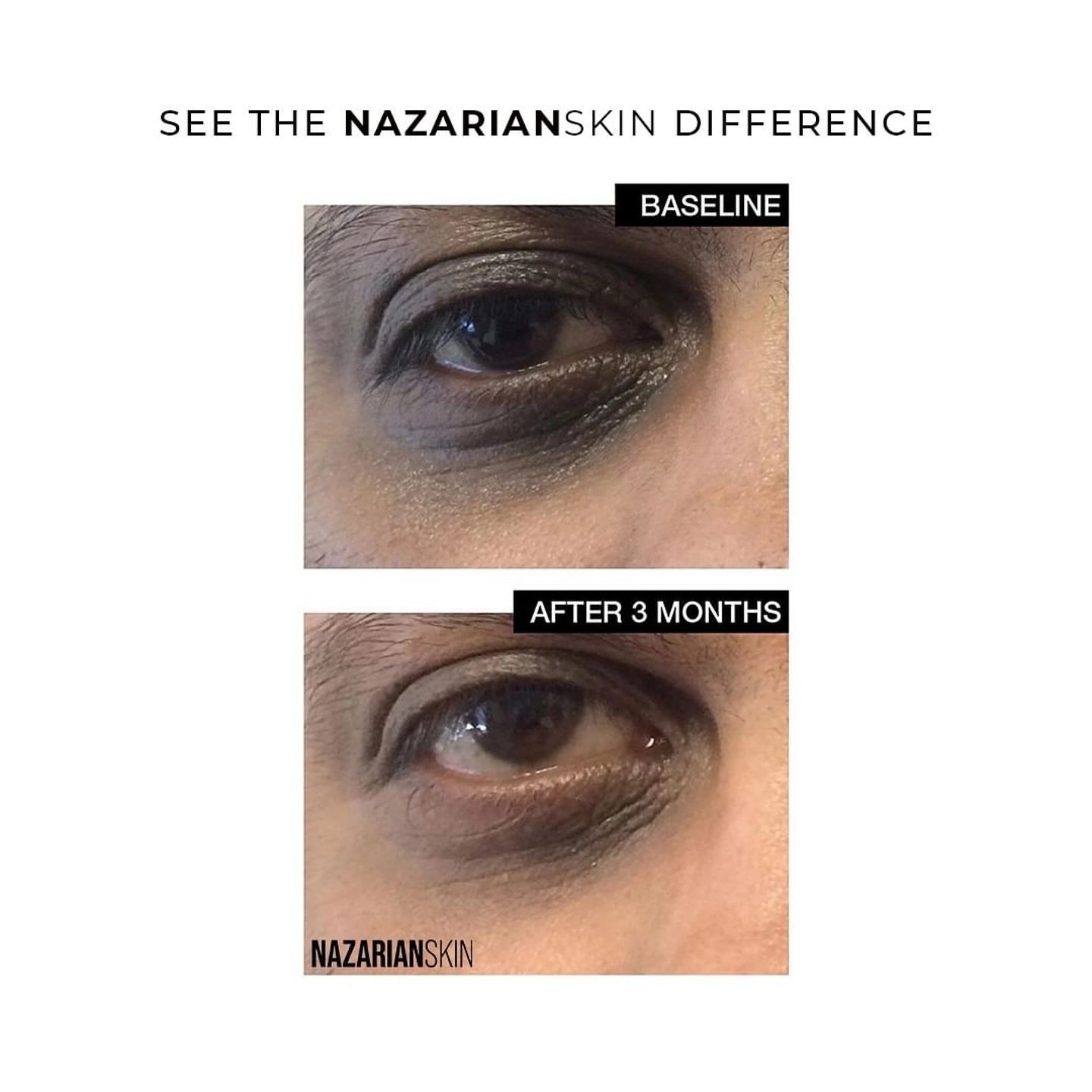 NazarianSkin Smooth Eye Peptide Cream before and after 3 weeks: visibly reduced dark circles, puffiness, and fine lines.