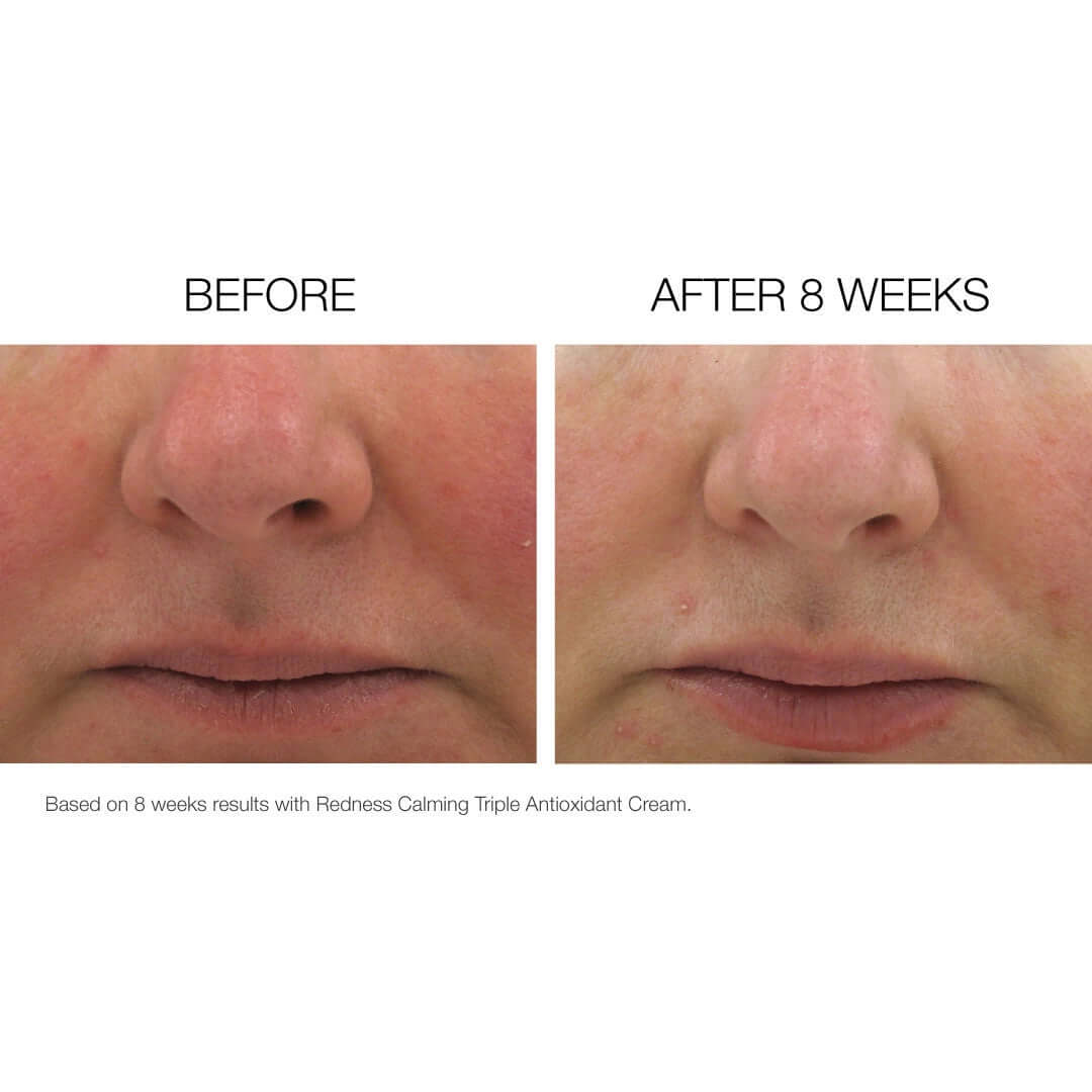 Before and after results with NazarianSkin Triple Antiox serum showing reduced redness and smoother skin after 8 weeks
