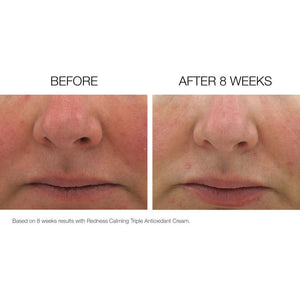 Before and after results with NazarianSkin Triple Antiox serum showing reduced redness and smoother skin after 8 weeks
