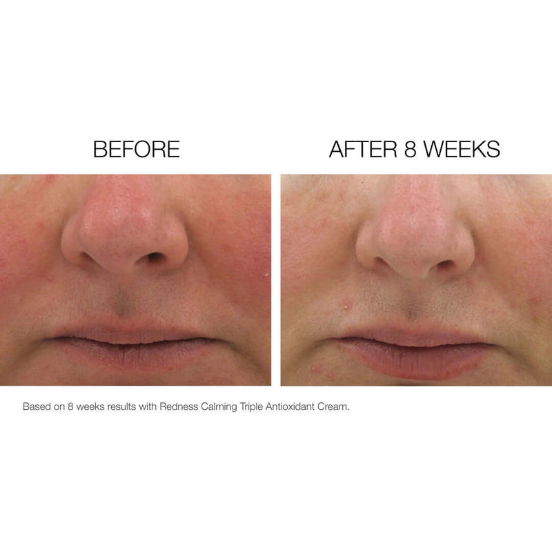 Before and after results with NazarianSkin Triple Antiox serum showing reduced redness and smoother skin after 8 weeks