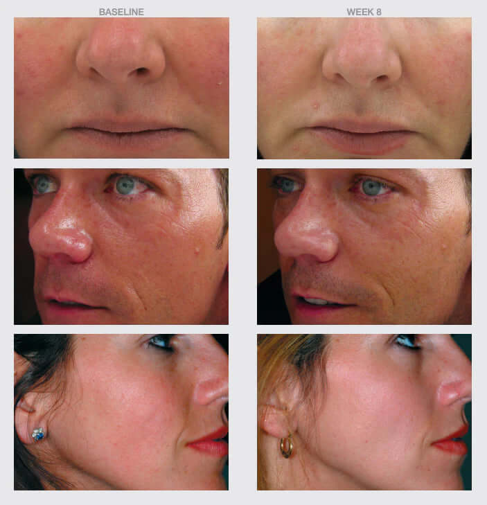 NazarianSkin triple antiox serum before after results week 8 showing smoother brighter skin reduced redness fine lines
