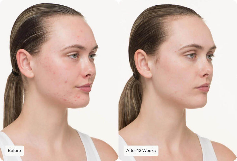 Nutrafol- Clear Skin Nutraceutical-The Skin Spot
