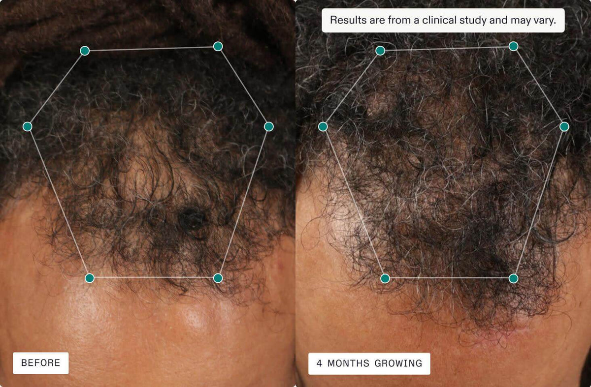 Nutrafol Core for Men before and 4 months growing comparison shows men's hairline coverage and fuller-looking growth result.