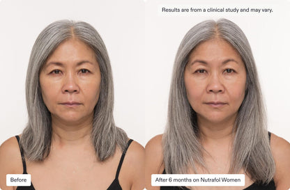 Before and after 6 months on Nutrafol Core for Women, showing improved hair fullness and texture in an Asian woman.