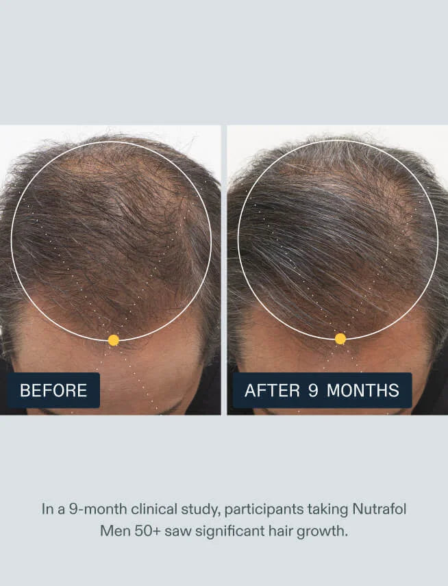 Before and after 9 months of Nutrafol Men 50+ showing top-of-scalp hair density in a clinical study