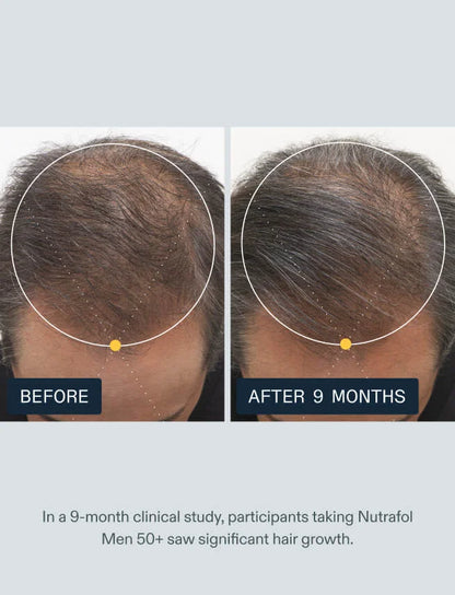 Before and after 9 months of Nutrafol Men 50+ showing top-of-scalp hair density in a clinical study