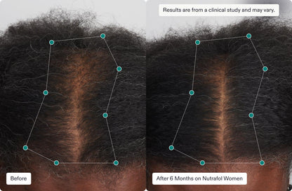 Before and after 6 months on Nutrafol Women, showing significant hair regrowth and increased density on a woman's scalp.