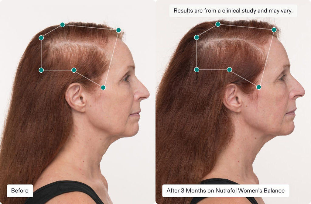 Before and after 3 months on Nutrafol Women's Balance, demonstrating significant hair regrowth and increased density in a woman