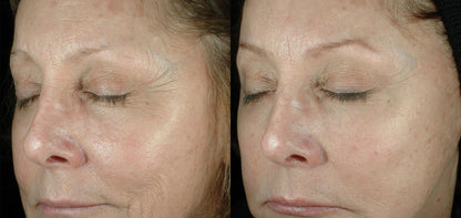 Before and after using Obagi ELASTIderm Eye Cream, demonstrating visible reduction in fine lines