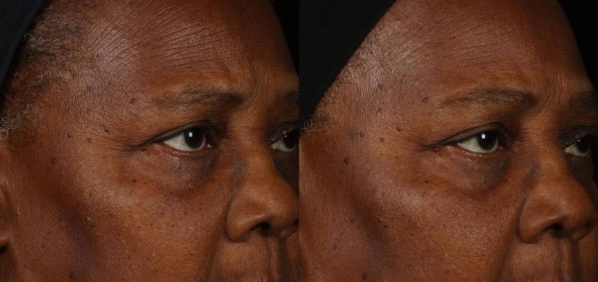 Obagi ELASTIderm Facial Serum before and after comparison shows eye area texture and firmer-looking skin around lines now...