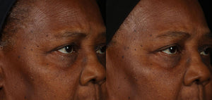 Obagi ELASTIderm Facial Serum before and after comparison shows eye area texture and firmer-looking skin around lines now...
