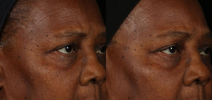 Obagi ELASTIderm Facial Serum before and after comparison shows eye area texture and firmer-looking skin around lines now...