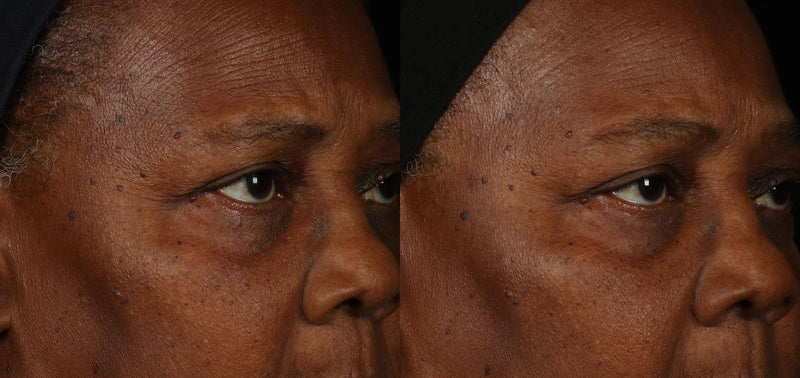 Obagi ELASTIderm Facial Serum before and after comparison shows eye area texture and firmer-looking skin around lines now...