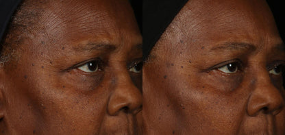 Before and after using Obagi ELASTIderm Facial Serum, demonstrating improved skin texture and reduced appearance of fine lines