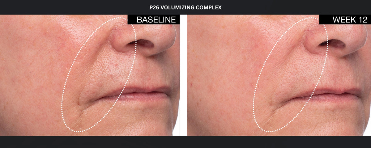 P26 Volumizing Complex before and after photos showing cheek area at baseline and week 12 for facial volume support results.