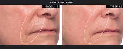 P26 Volumizing Complex before and after photos showing cheek area at baseline and week 12 for facial volume support results.