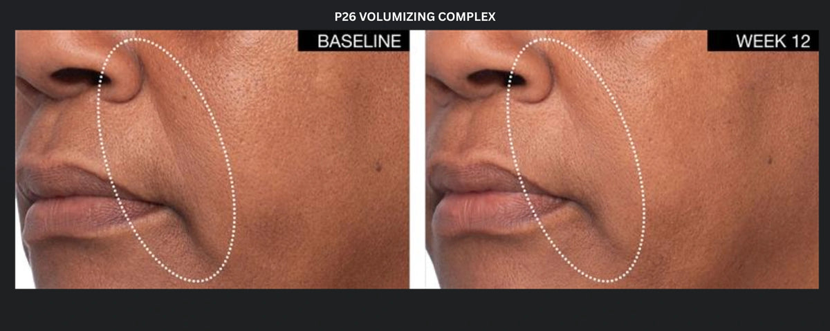 P26 Volumizing Complex before and after photos showing smile line area at baseline and week 12 for facial volume