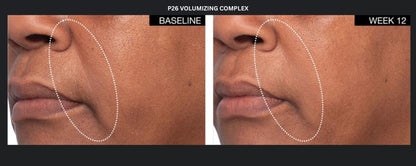 P26 Volumizing Complex before and after photos showing smile line area at baseline and week 12 for facial volume