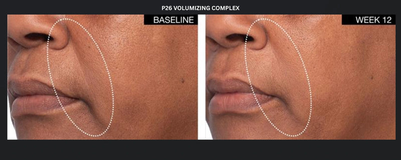 P26 Volumizing Complex before and after photos showing smile line area at baseline and week 12 for facial volume