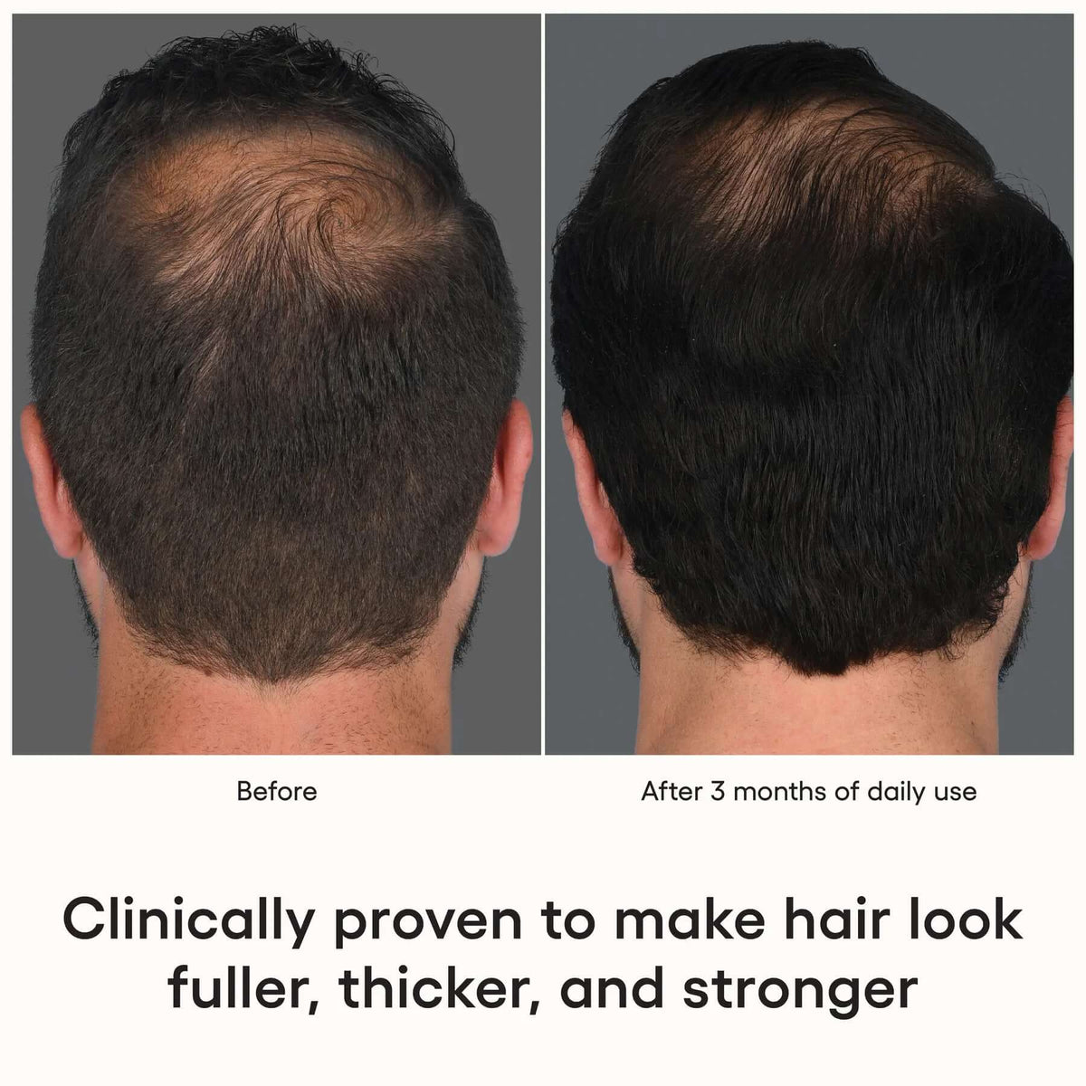 ( plated ) HAIR Serum before and after 3 months shows fuller, thicker-looking hair with daily Renewosome scalp serum use..