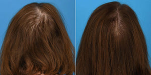 ( plated ) HAIR Serum before and after photo shows improved hair density and fuller-looking coverage on thinning scalp now..