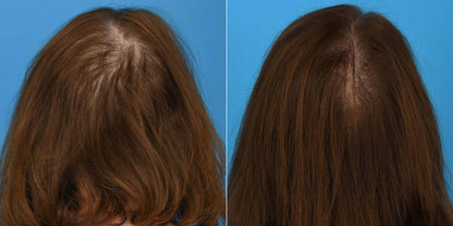 ( plated ) HAIR Serum before and after photo shows improved hair density and fuller-looking coverage on thinning scalp now..