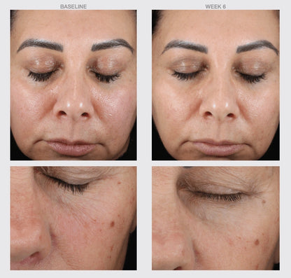 Retinol max strength cream before and after 6 weeks results showing smoother skin reduced wrinkles improved tone texture
