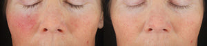 Before and after using Revision Skincare C+ Correcting Complex 30% showing improved skin tone and reduced redness