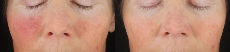 Before and after using Revision Skincare C+ Correcting Complex 30% showing improved skin tone and reduced redness