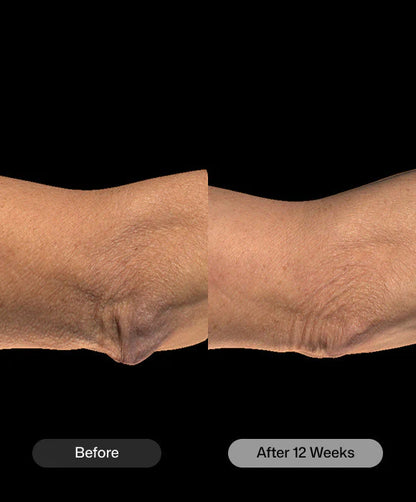 Before and after skin appearance comparison after 12 weeks using Revision Skincare BodiFirm body lotion