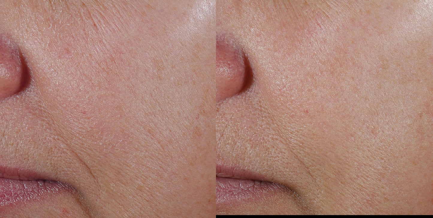 Before and after using Revision Skincare Vitamin C 30%, demonstrating enhanced skin texture and reduced fine lines