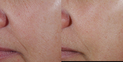 Before and after using Revision Skincare Vitamin C 30%, demonstrating enhanced skin texture and reduced fine lines