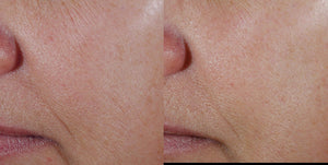 Before and after skin texture results using Revision Skincare Vitamin C treatment for improved tone and skin clarity