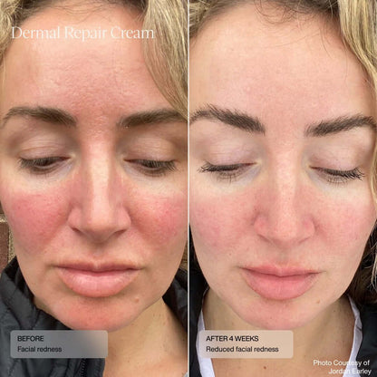 Senté Dermal Repair Cream before and after redness result showing calmer facial skin after four weeks of daily use.