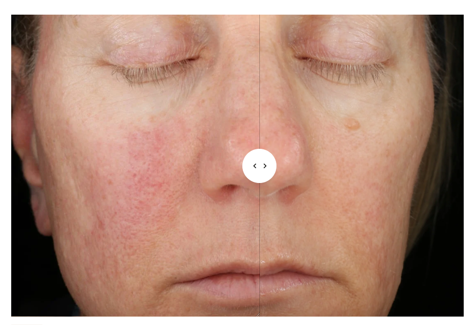 Before and after using SENTÉ Dermal Repair Cream, showing reduced facial redness and improved skin texture