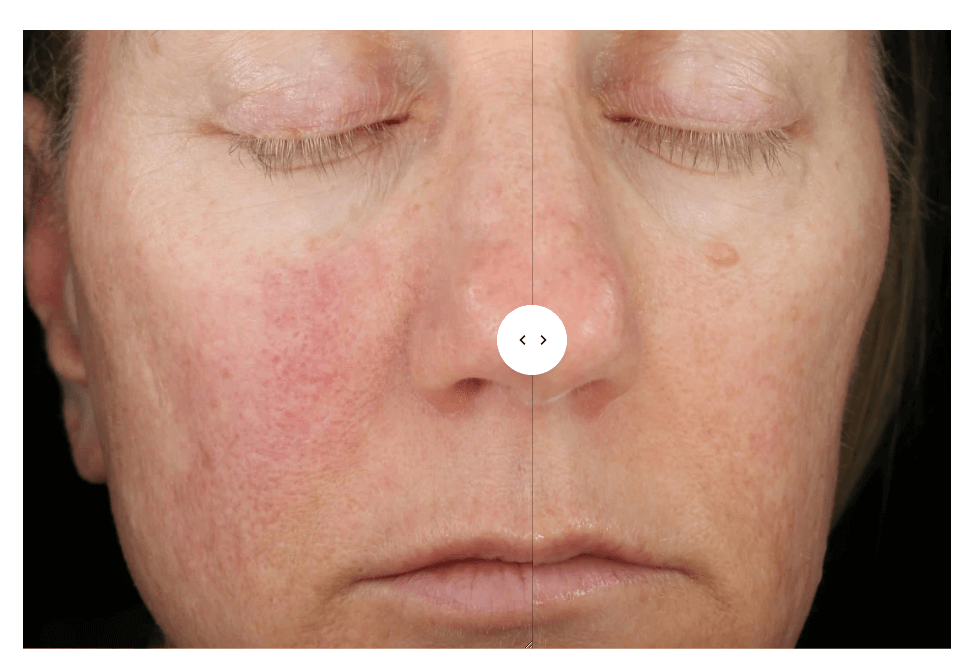 Senté Dermal Repair Cream redness comparison image showing improved skin tone and visibly calmer facial skin results.