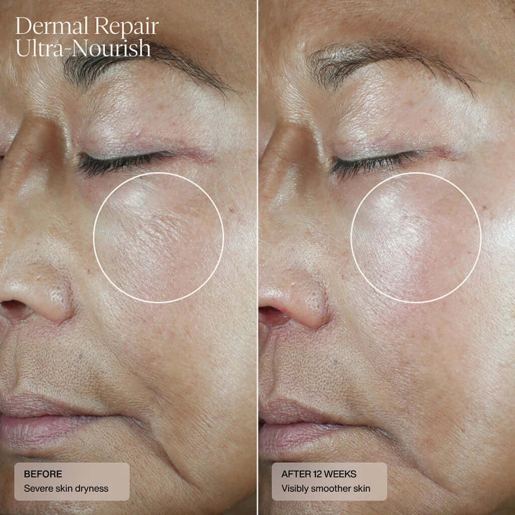 Senté Dermal Repair Ultra-Nourish before and after result showing visibly smoother skin after twelve weeks of use.
