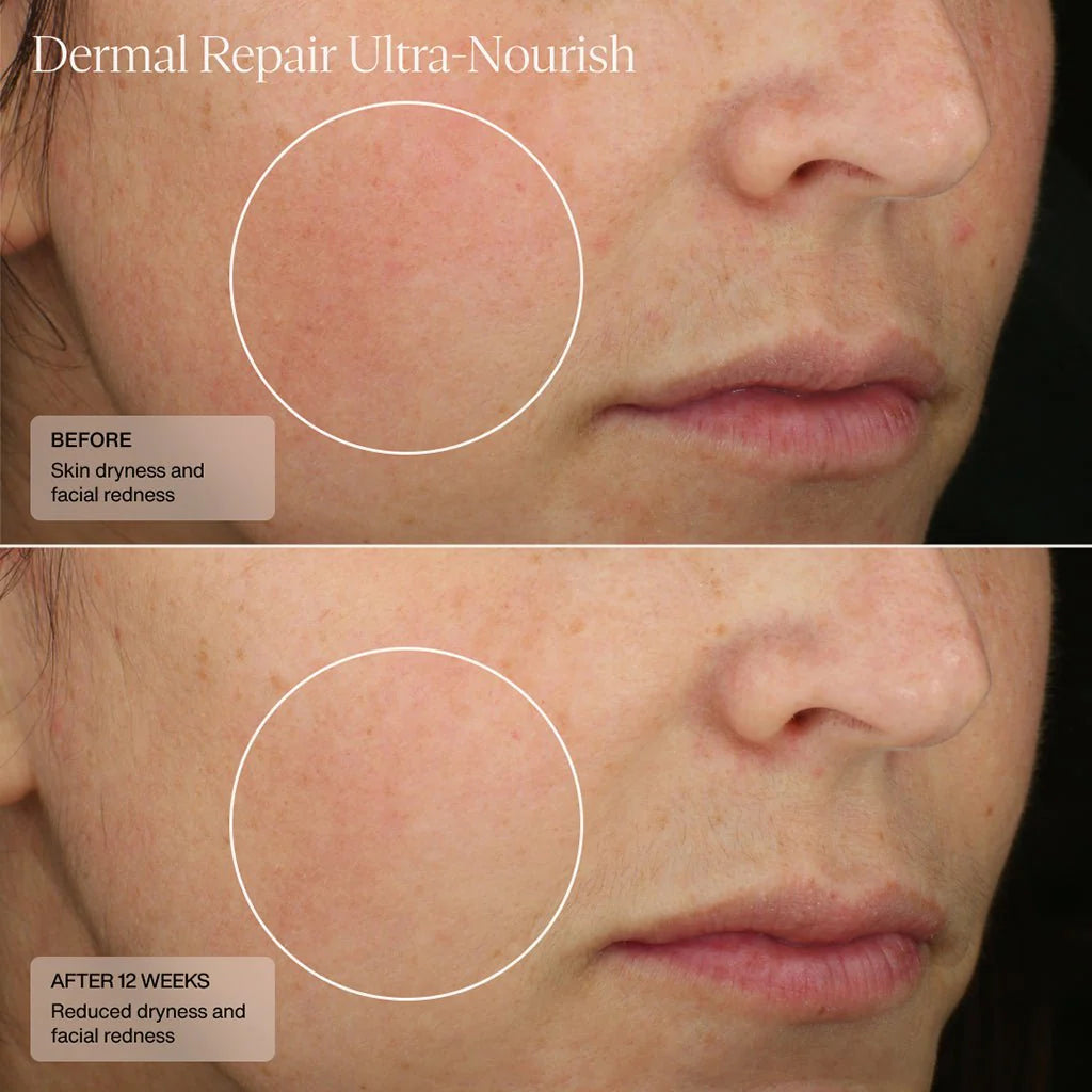 Before and after using SENTÉ Dermal Repair Ultra-Nourish, 12-week results showing reduced skin dryness and facial redness