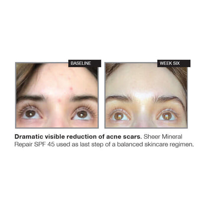 NazarianSkin Sheer Mineral SPF 45 sunscreen acne scar reduction before and after results showing clearer skin improvement