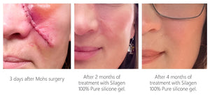 Three-stage scar healing progression showing results at 3 days post-Mohs surgery, then after 2 months and 4 months of treatment with Silagen 100% pure silicone gel.