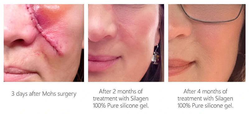 Three-stage scar healing progression showing results at 3 days post-Mohs surgery, then after 2 months and 4 months of treatment with Silagen 100% pure silicone gel.