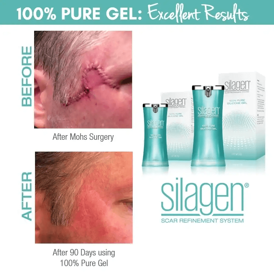 Before and after comparison of Mohs surgery scar treated with Silagen 100% pure silicone gel, showing significant improvement after 90 days of use.
