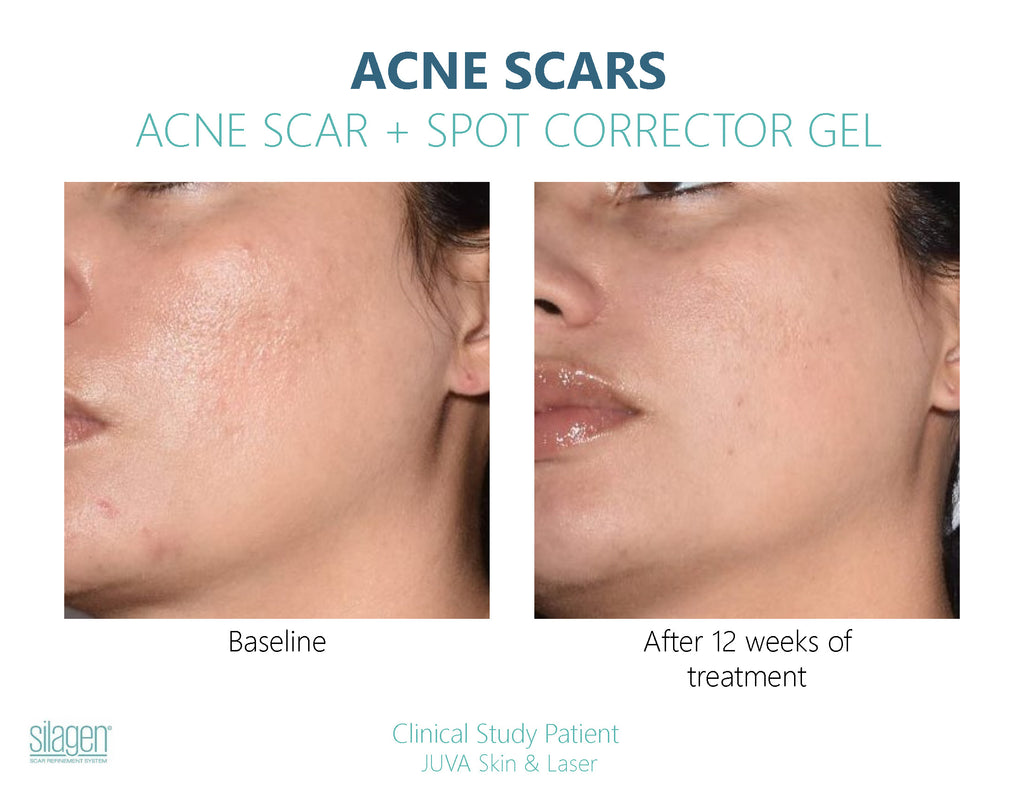 Before and after using Silagen Acne Scar + Spot Corrector for 12 weeks, showing reduced acne scars and smoother skin