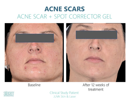 Before and after using Silagen Acne Scar + Spot Corrector for 12 weeks, showing reduced acne scars and improved skin clarity