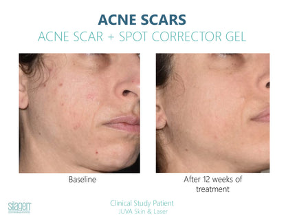 Before and after using Silagen Acne Scar + Spot Corrector for 12 weeks, showing reduced acne scars and improved skin