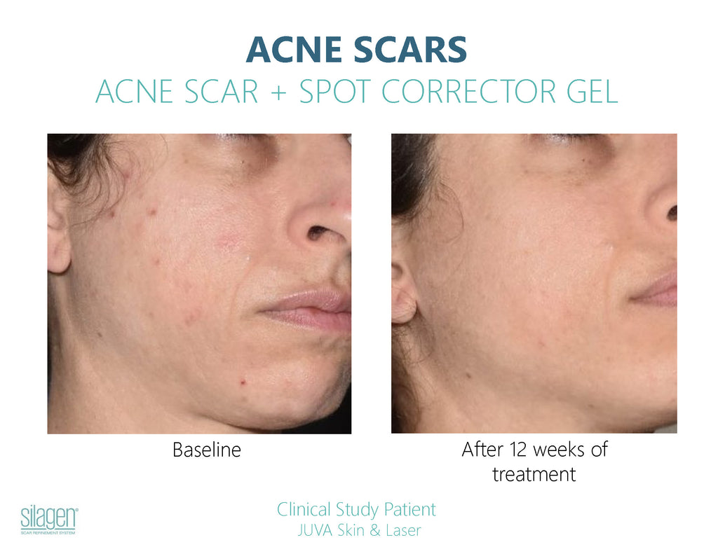 Before and after using Silagen Acne Scar + Spot Corrector for 12 weeks, showing reduced acne scars and improved skin