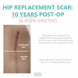Split-comparison of a 10-year-old hip replacement scar after 3 weeks of Silagen sheeting. The untreated half appears more raised and discolored, while the treated half shows visible improvement in flatness and color.