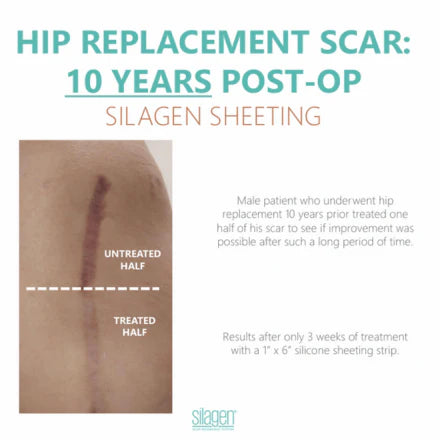 Split-comparison of a 10-year-old hip replacement scar after 3 weeks of Silagen sheeting. The untreated half appears more raised and discolored, while the treated half shows visible improvement in flatness and color.
